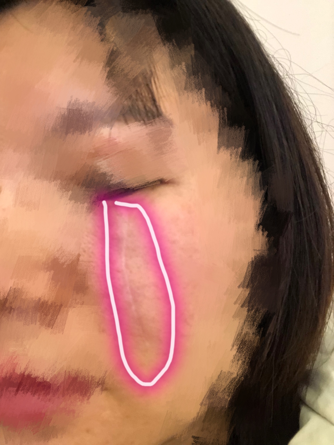 2019.1.11在杨教授那里做了脸上疤痕切缝手术，期待化妆无痕！ 面部凹陷疤痕,手术切缝