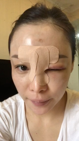 11月25日在杨东运教授这里做的眉心凹陷疤痕