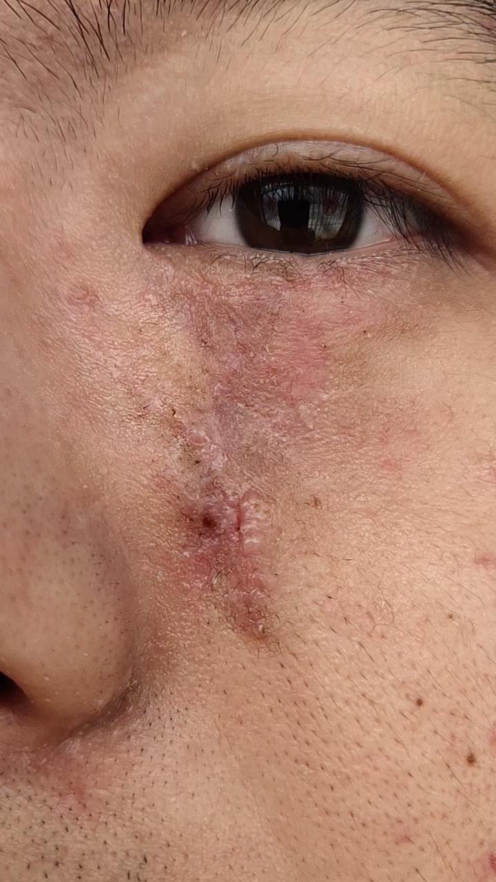 面部疤痕在杨教授这里做的切缝