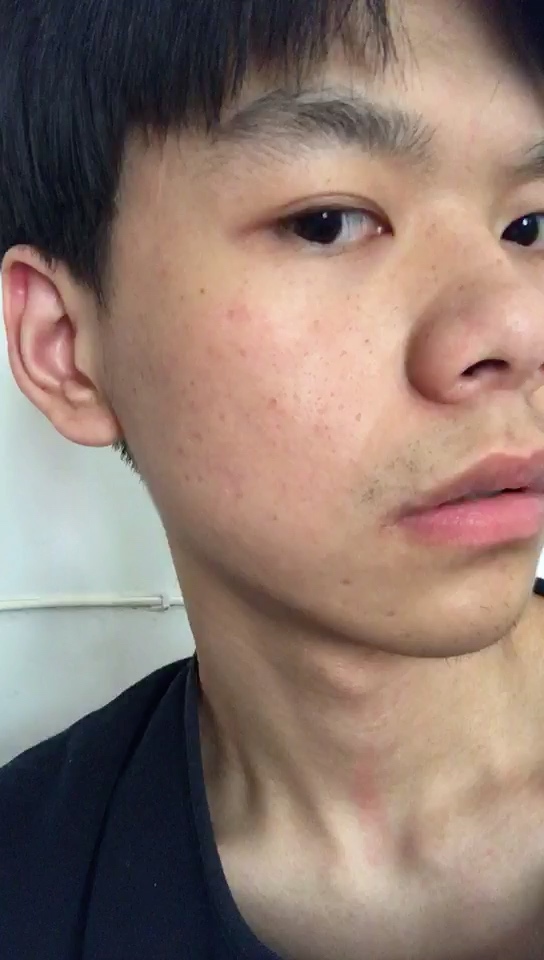 脸部水痘坑在天津做的切缝希望有好的效果