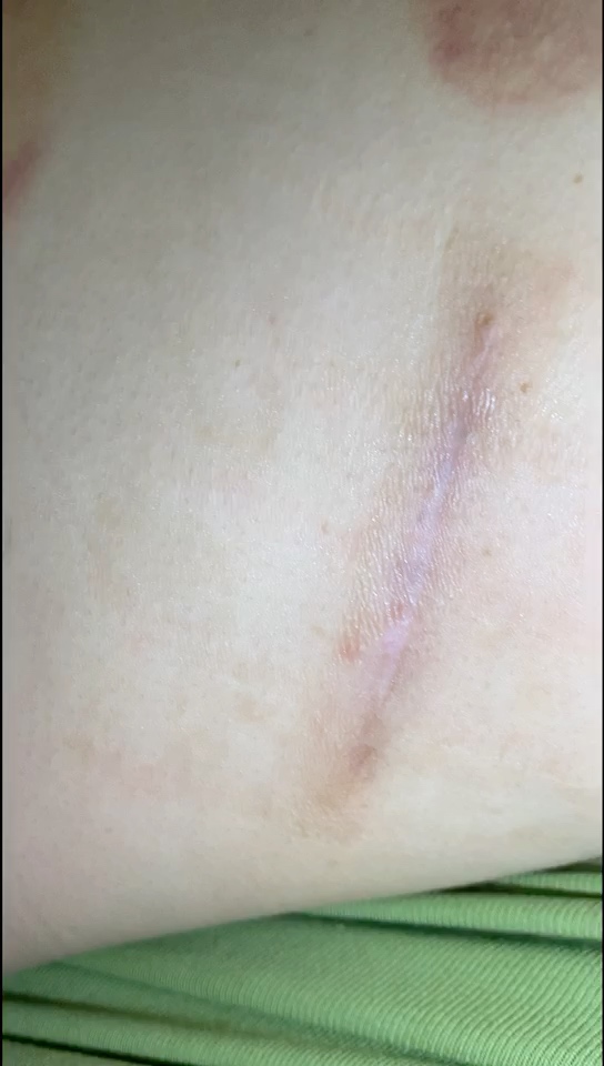右侧后背十年疤痕疙瘩手术切除配合放疗