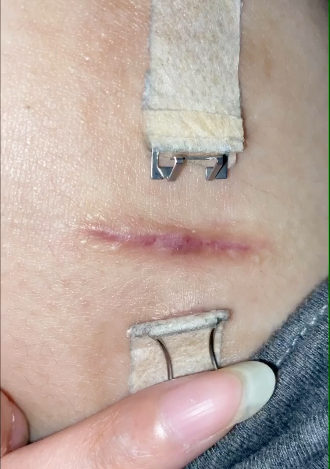 腿部凹陷疤痕切缝527