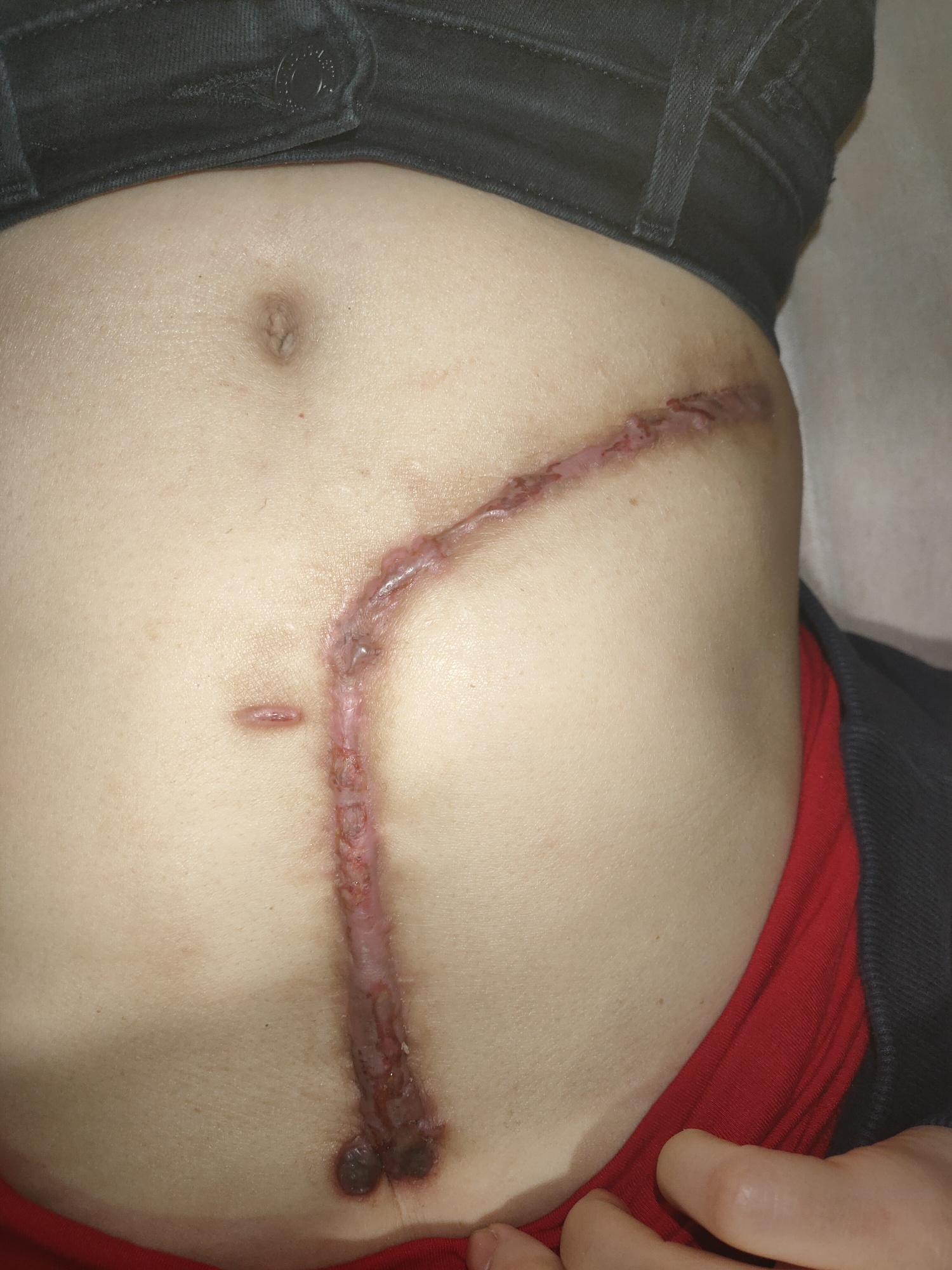腹部微创手术疤痕图片图片