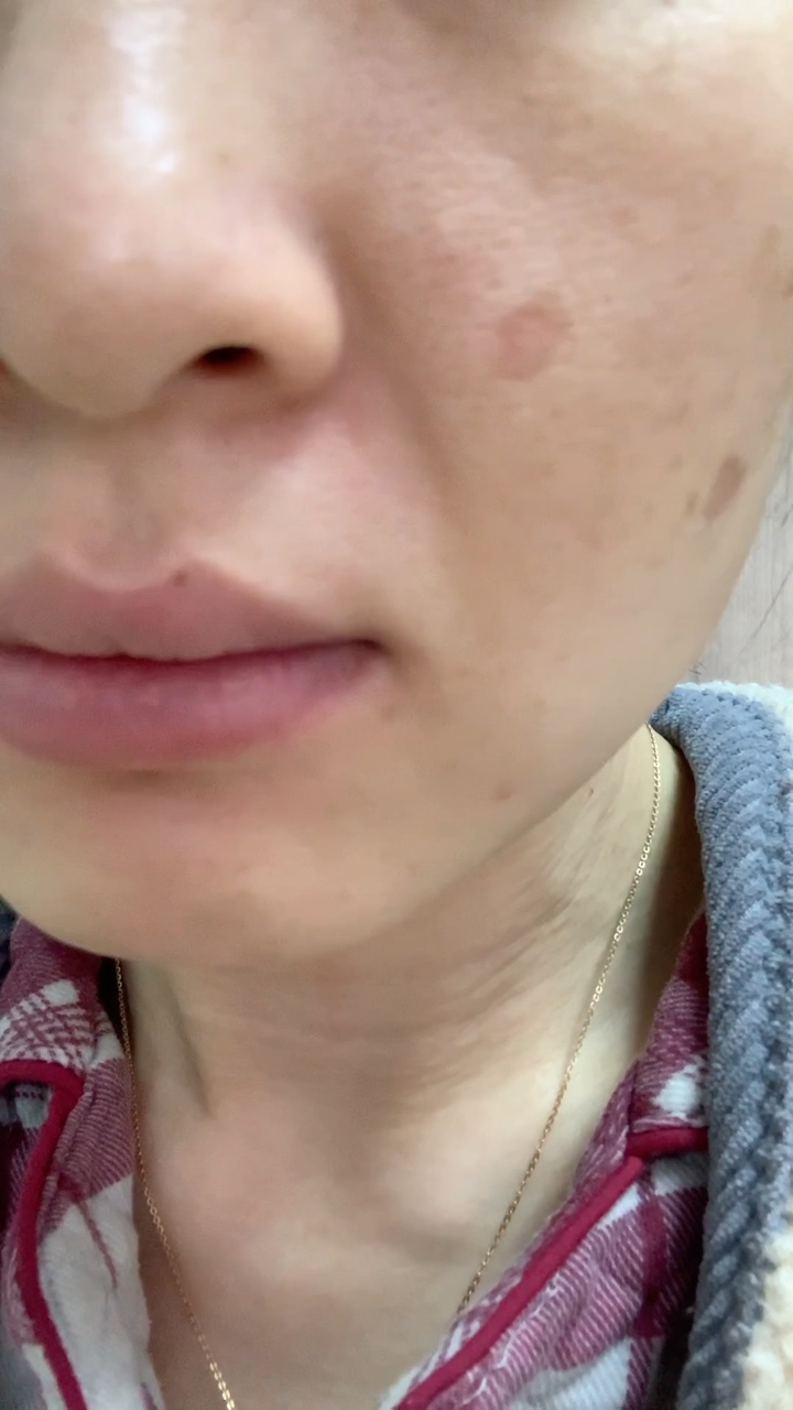 我的第一次真正意义上的磨削 点阵激光-疤痕论坛