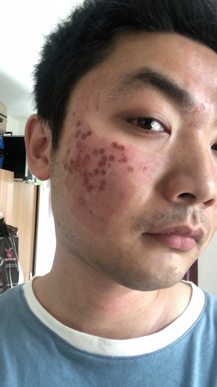 痘坑疤痕第二次去天津时光治疗