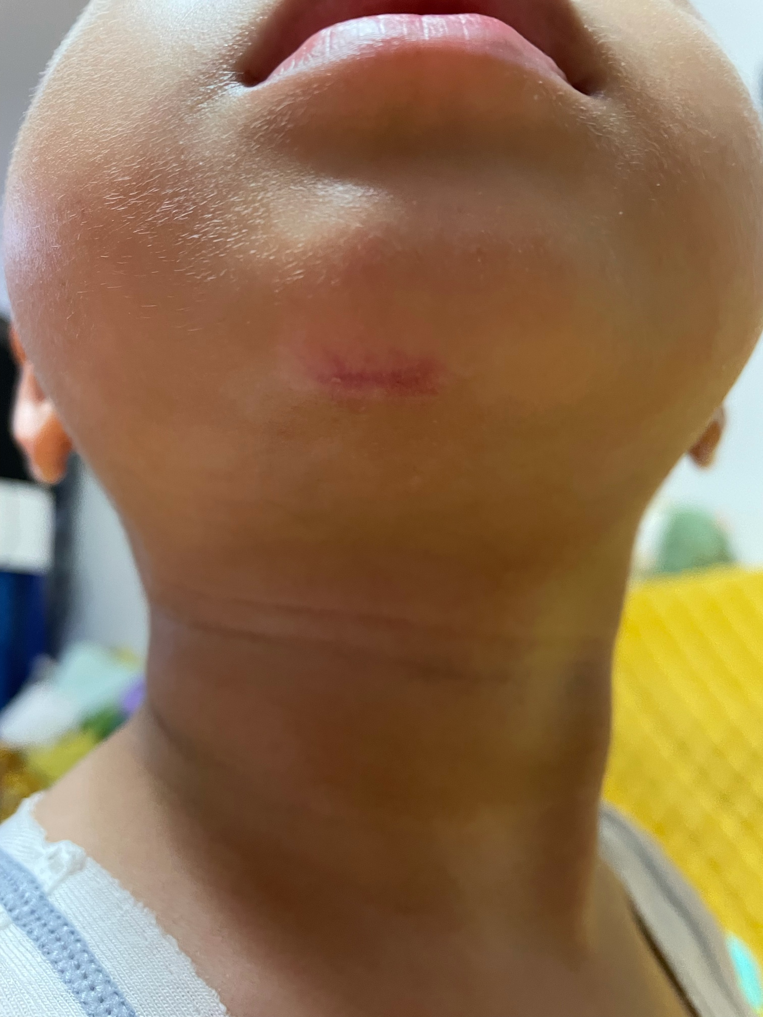 我儿子下巴磕伤，求助大家如何护理。 