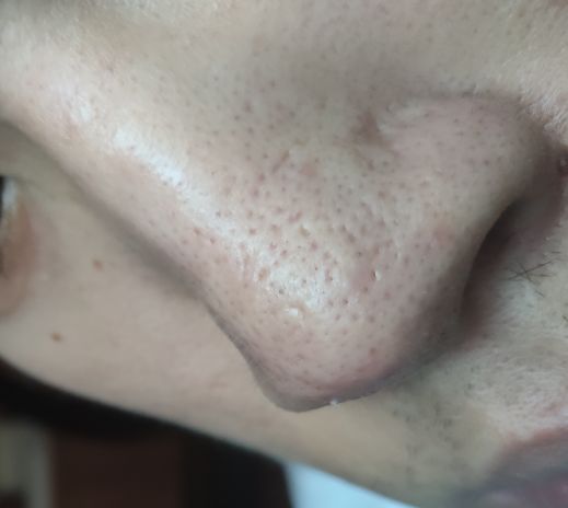 鼻子部位的毛孔坑如何修复？ 