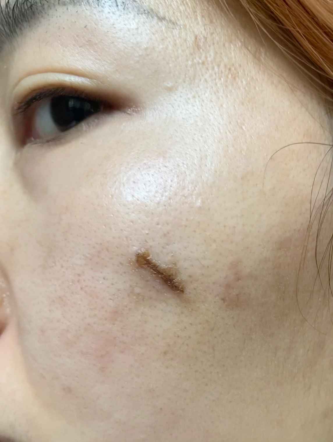 左面部凹陷疤痕切除