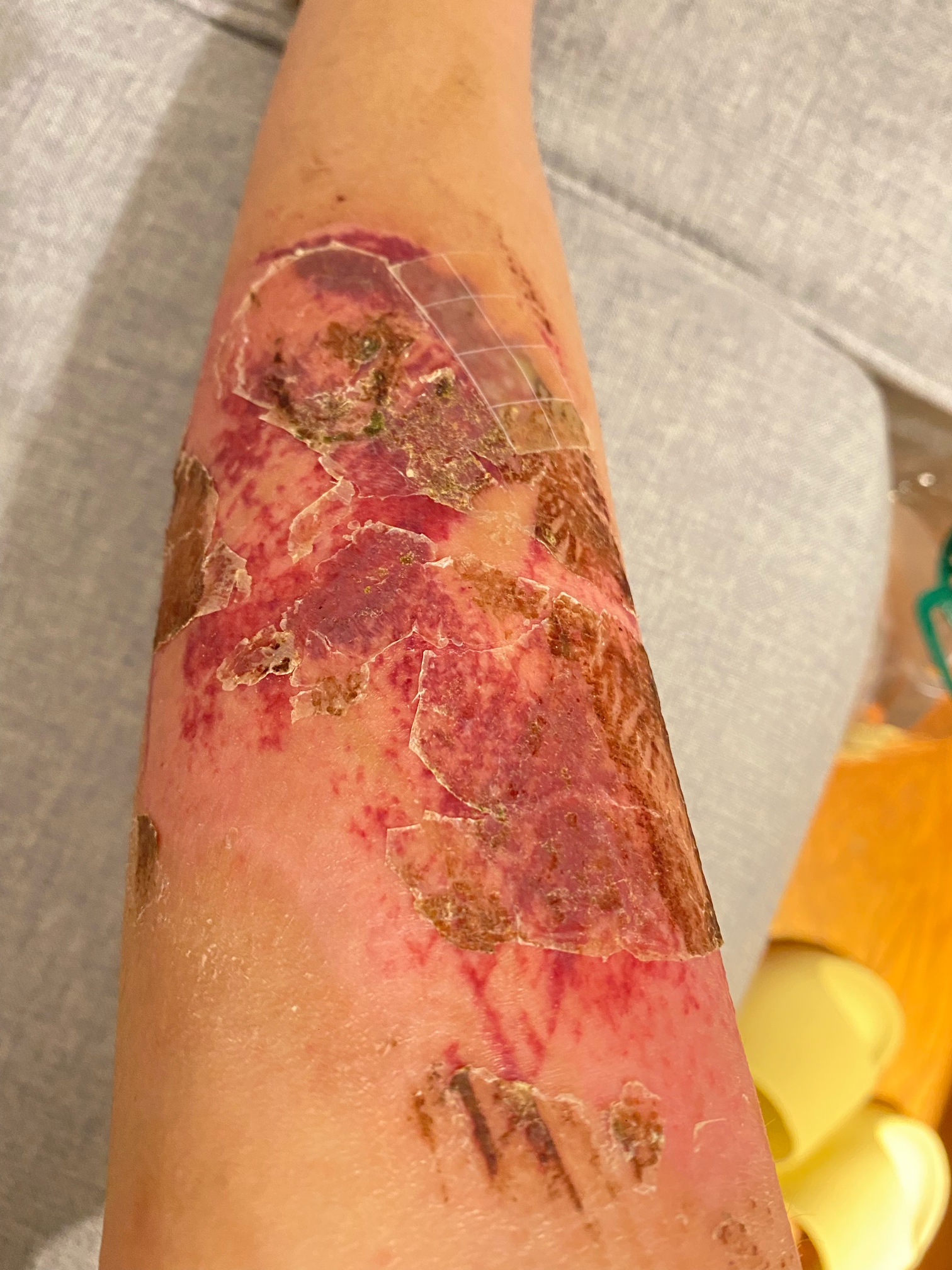 腿部疤痕十级伤残图片图片