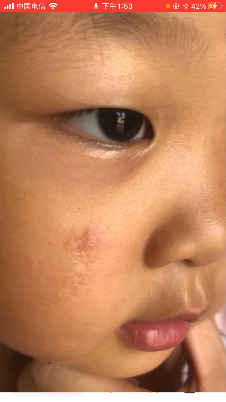 小孩面部受伤2年多，现在还能做激光吗？ 