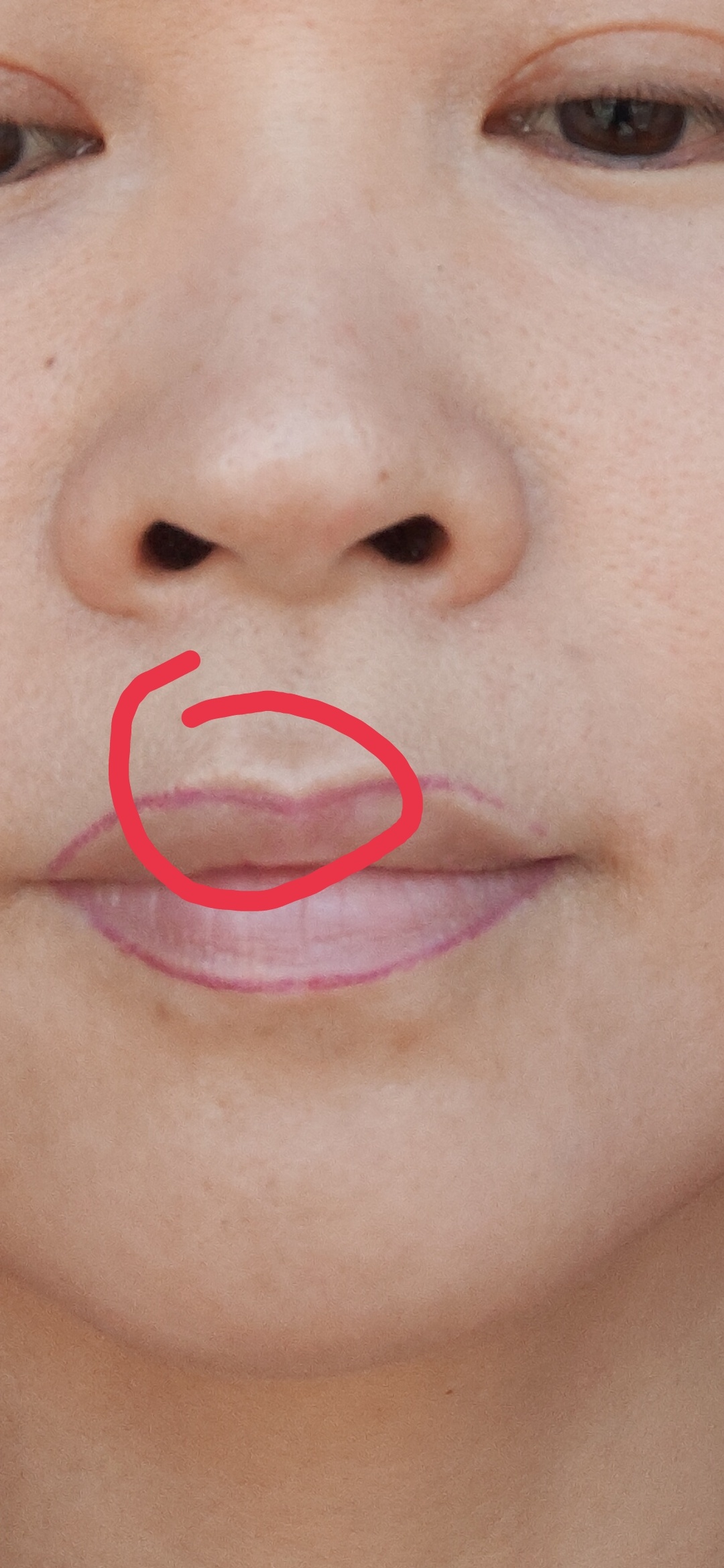 激光洗唇线导致的增生疤痕怎么去除？ 