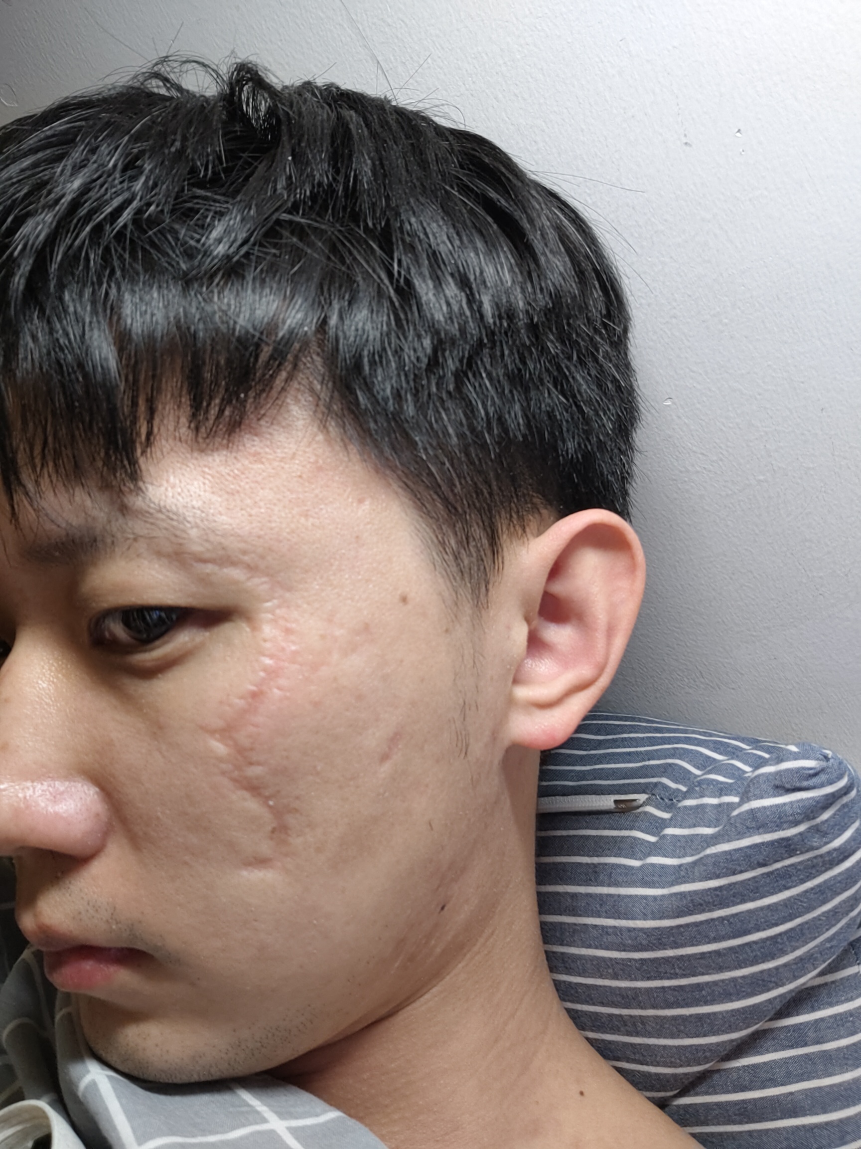 脸上十多年长的疤痕，求助如何治疗？ 
