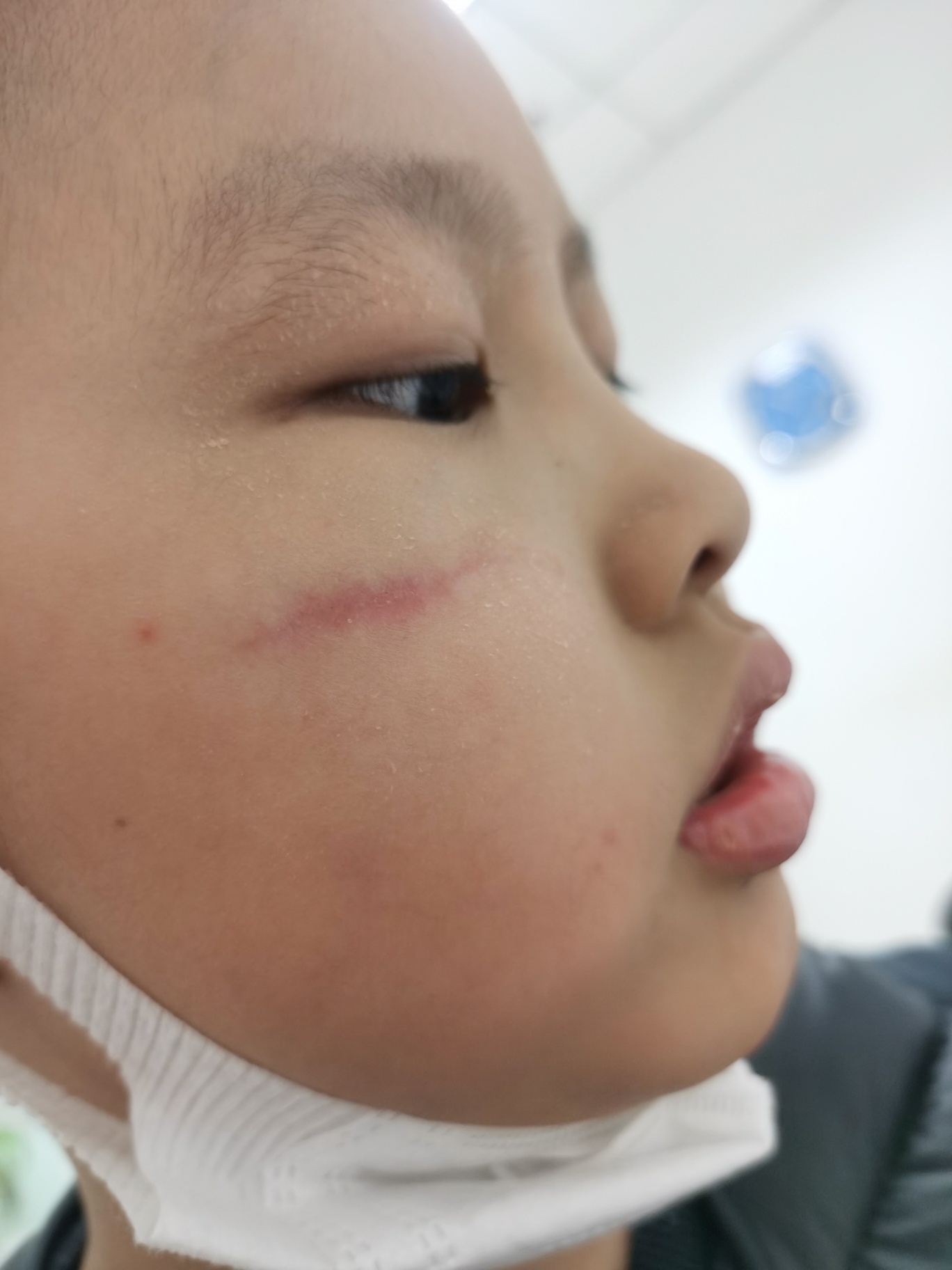 21年12月9号孩子脸颊部位受伤，如何护理？ 