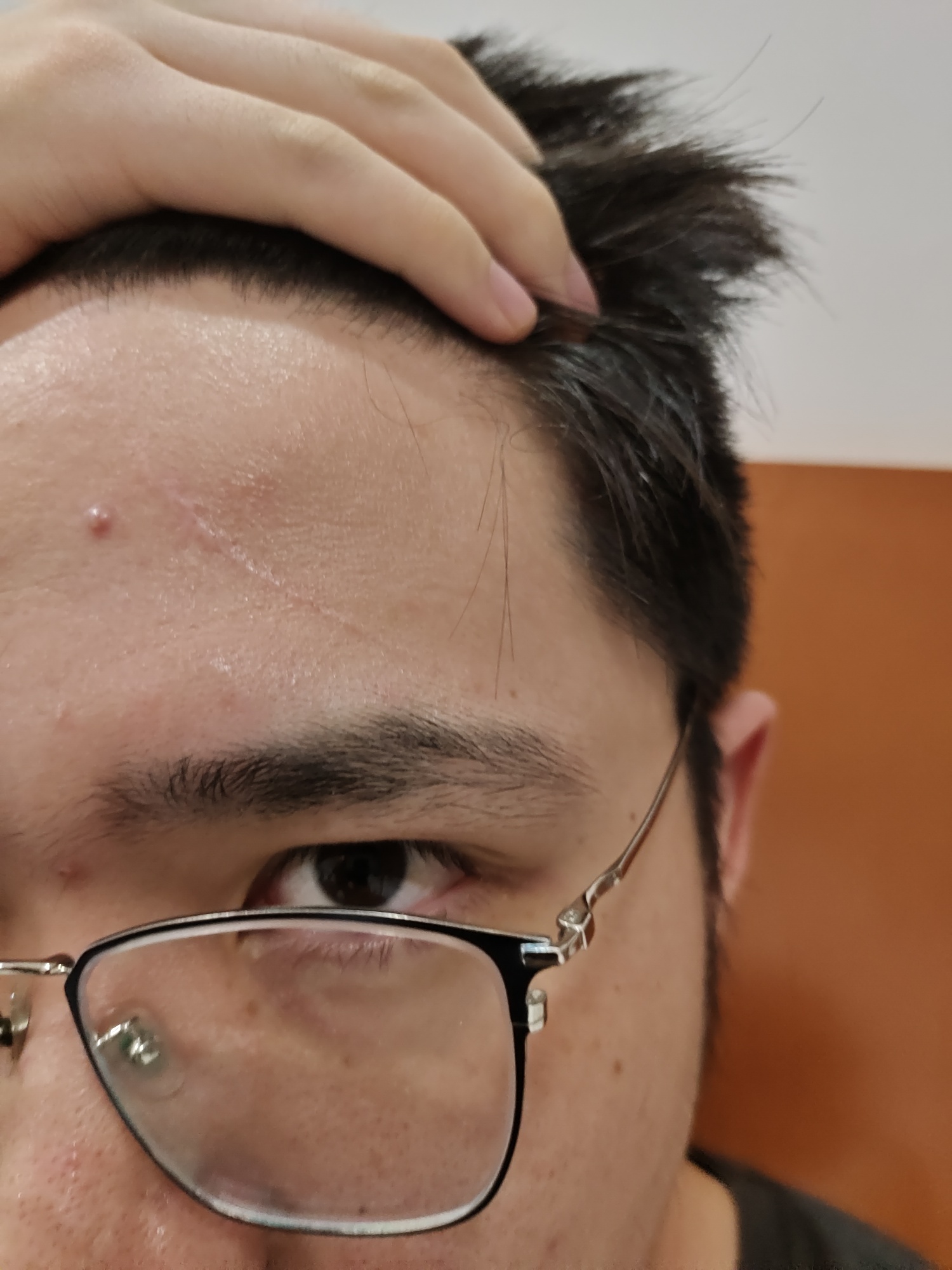 额头疤痕快十个月了，如何修复？ 