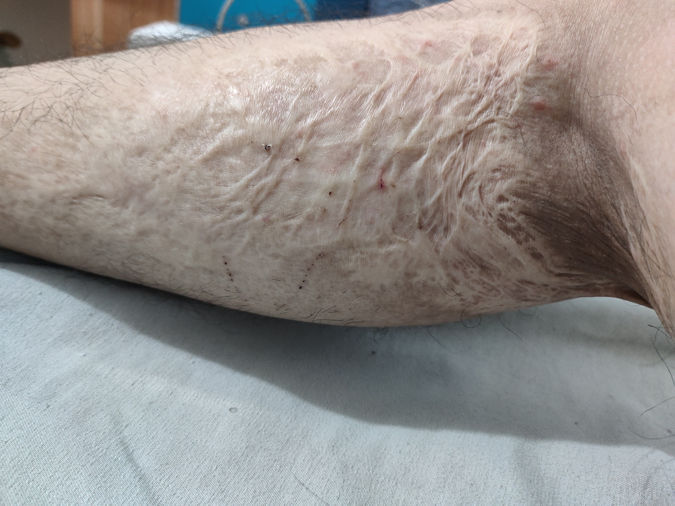 这种烧伤疤痕主要用什么手术治疗？ 