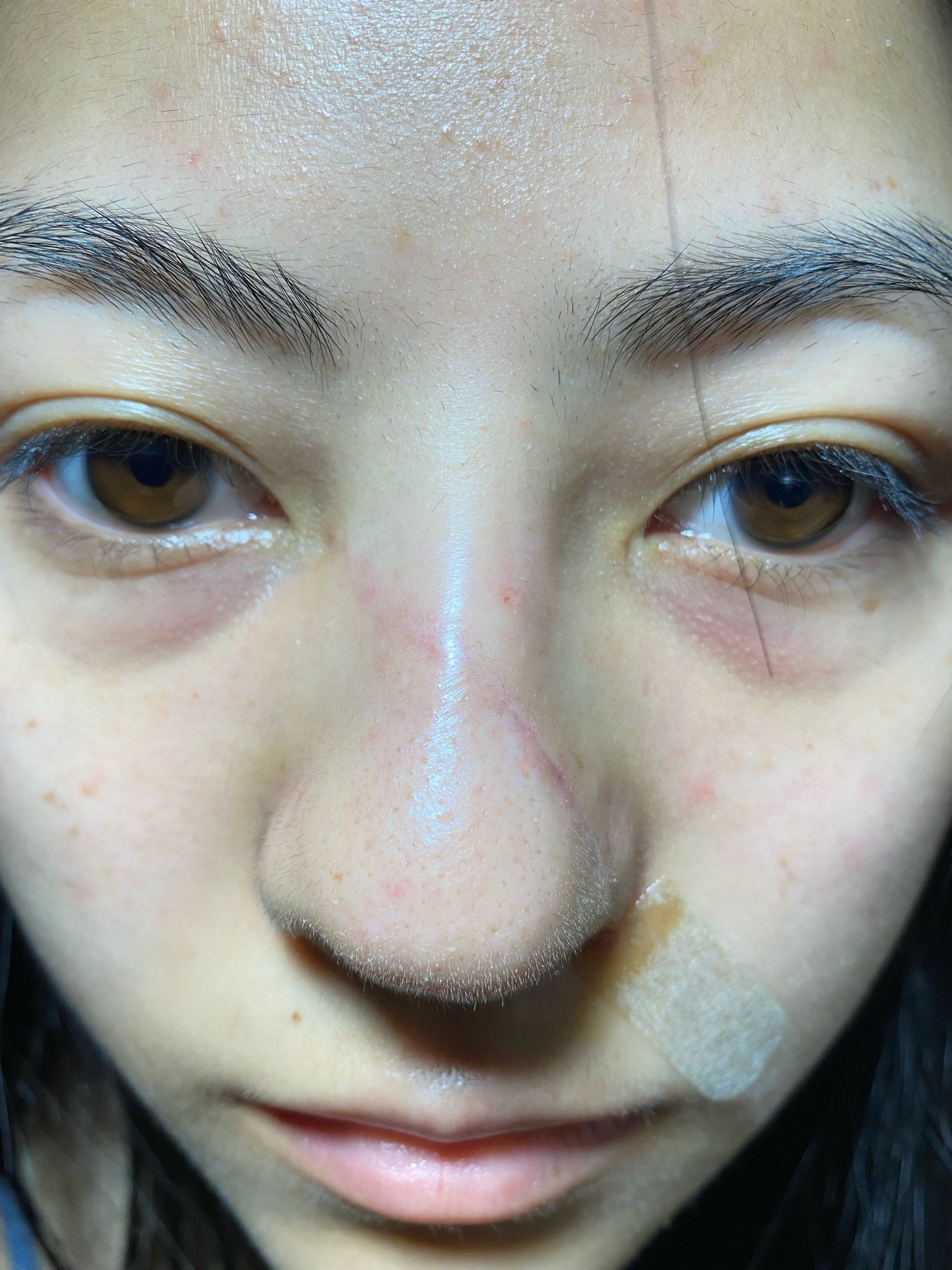 大家看看面部疤痕手术近期恢复的怎么样？ 