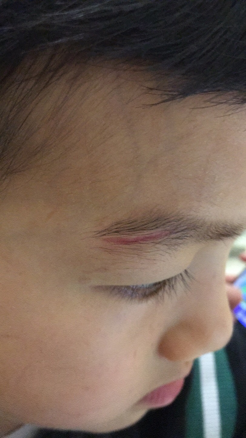 孩子磕伤眉毛，疫情封控导致没办法 