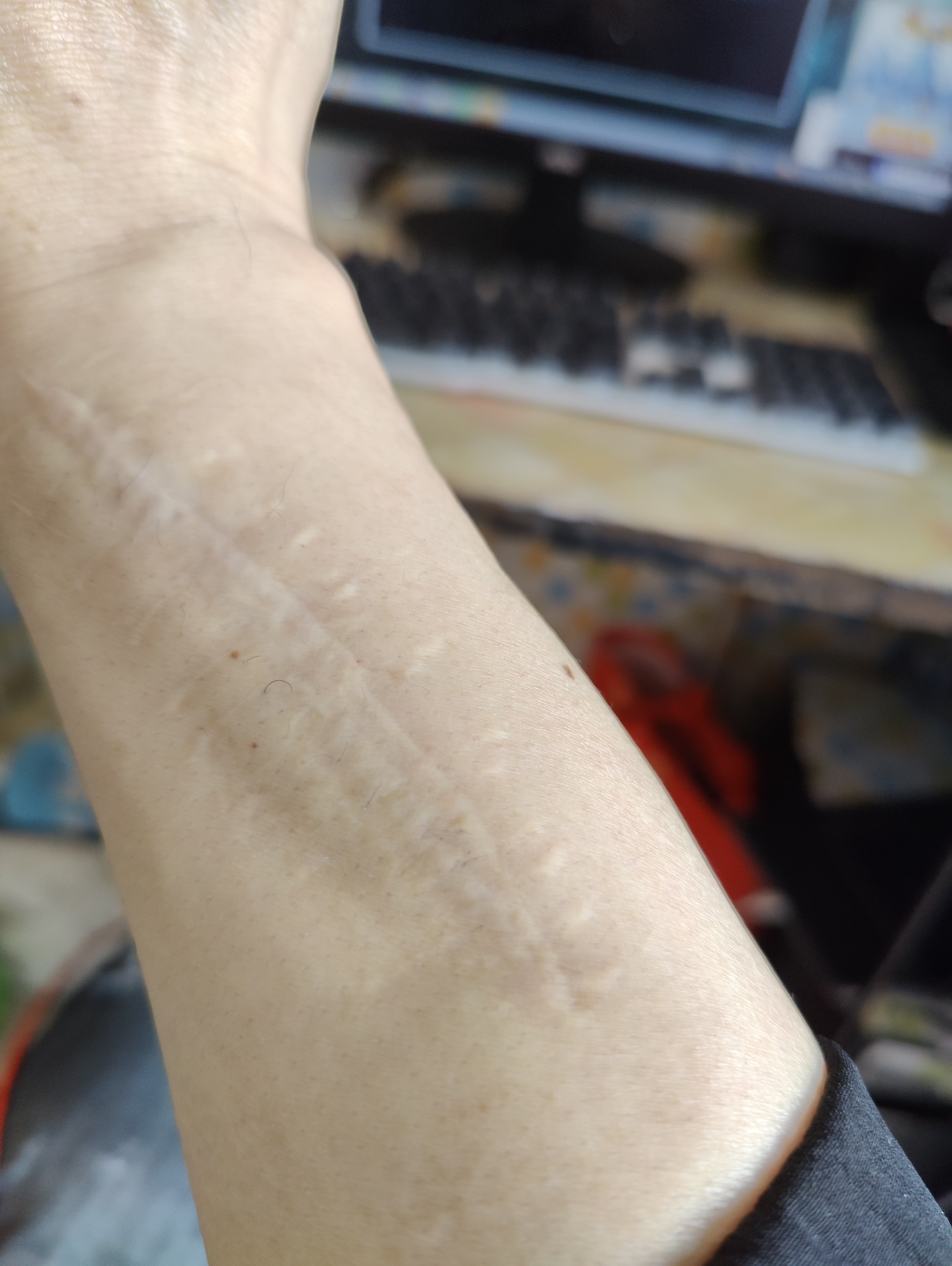 13年手术缝针留下的手臂疤痕，怎么修复？ 