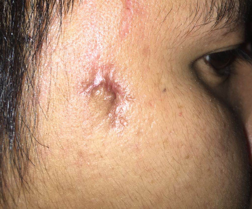 肤色较黑，脸上这个疤痕修复无痕的几率是多少？ 
