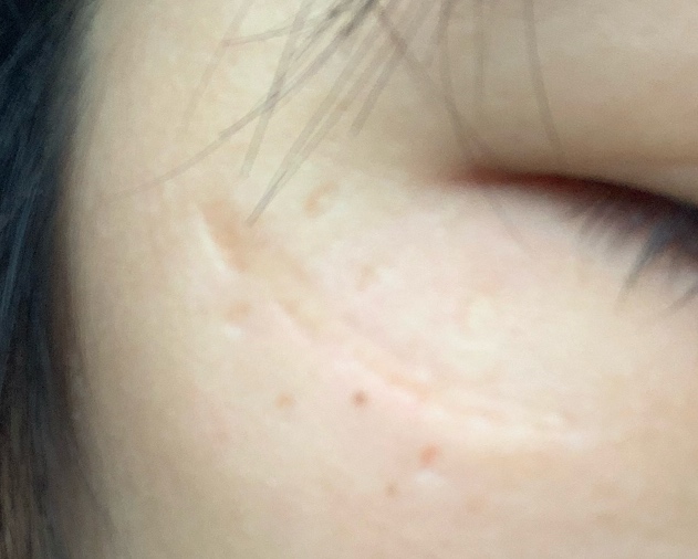 脸上凹陷疤痕最近想去疤痕手术，四川和重庆推荐谁？ 