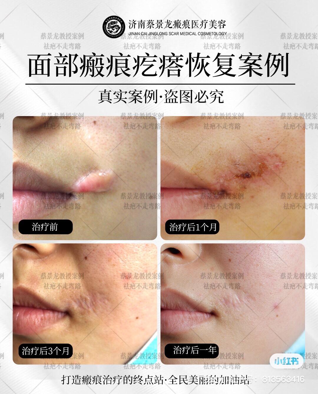 蔡景龙教授案例：面部疤痕疙瘩修复 