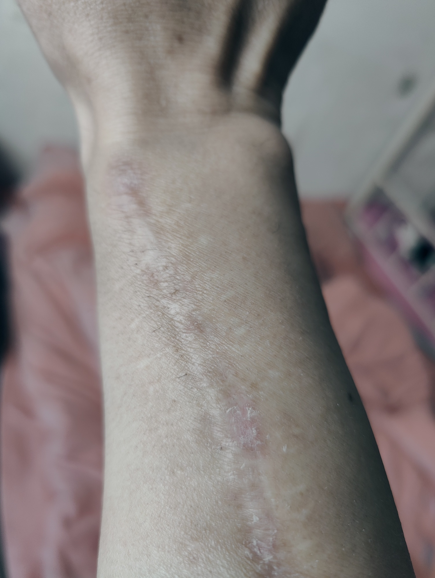 手臂长的疤痕十二年了，有什么方法 