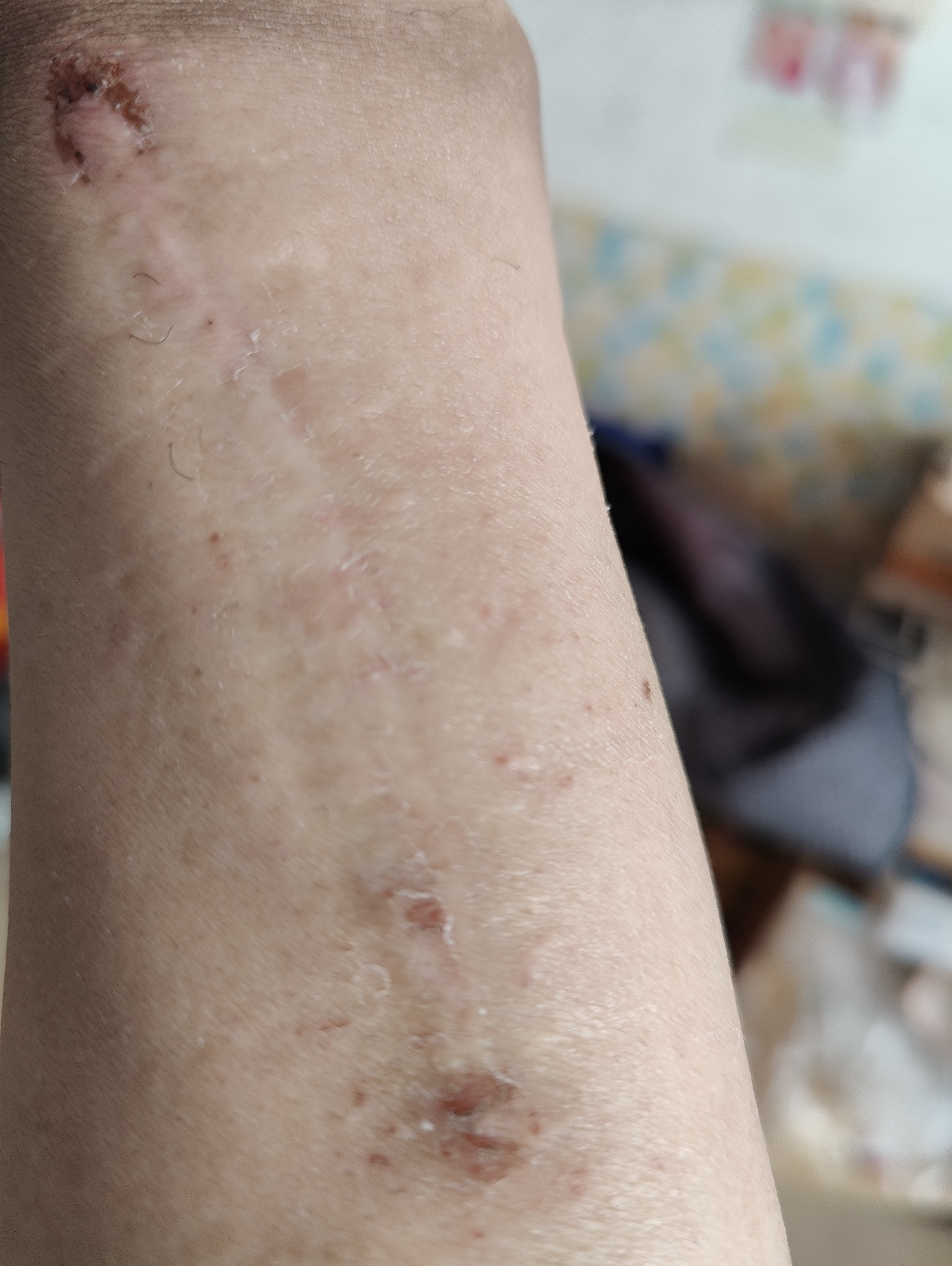手臂长的疤痕十二年了，有什么方法 