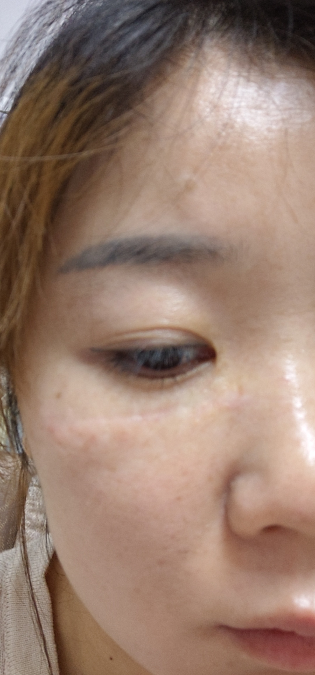 眼睛下面凹陷疤痕可以切缝吗？ 