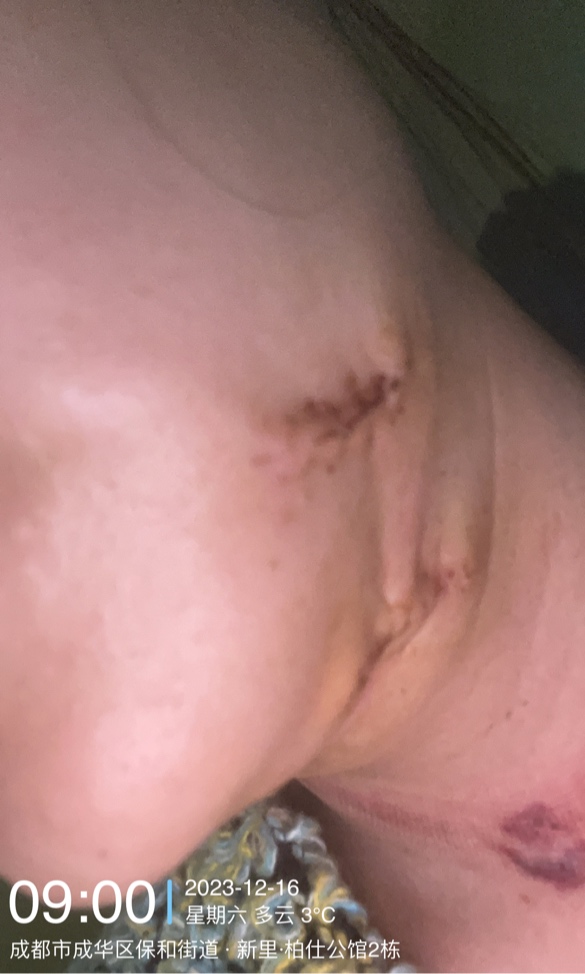 腮部疤痕疙瘩做了切割，颈部做了激光 