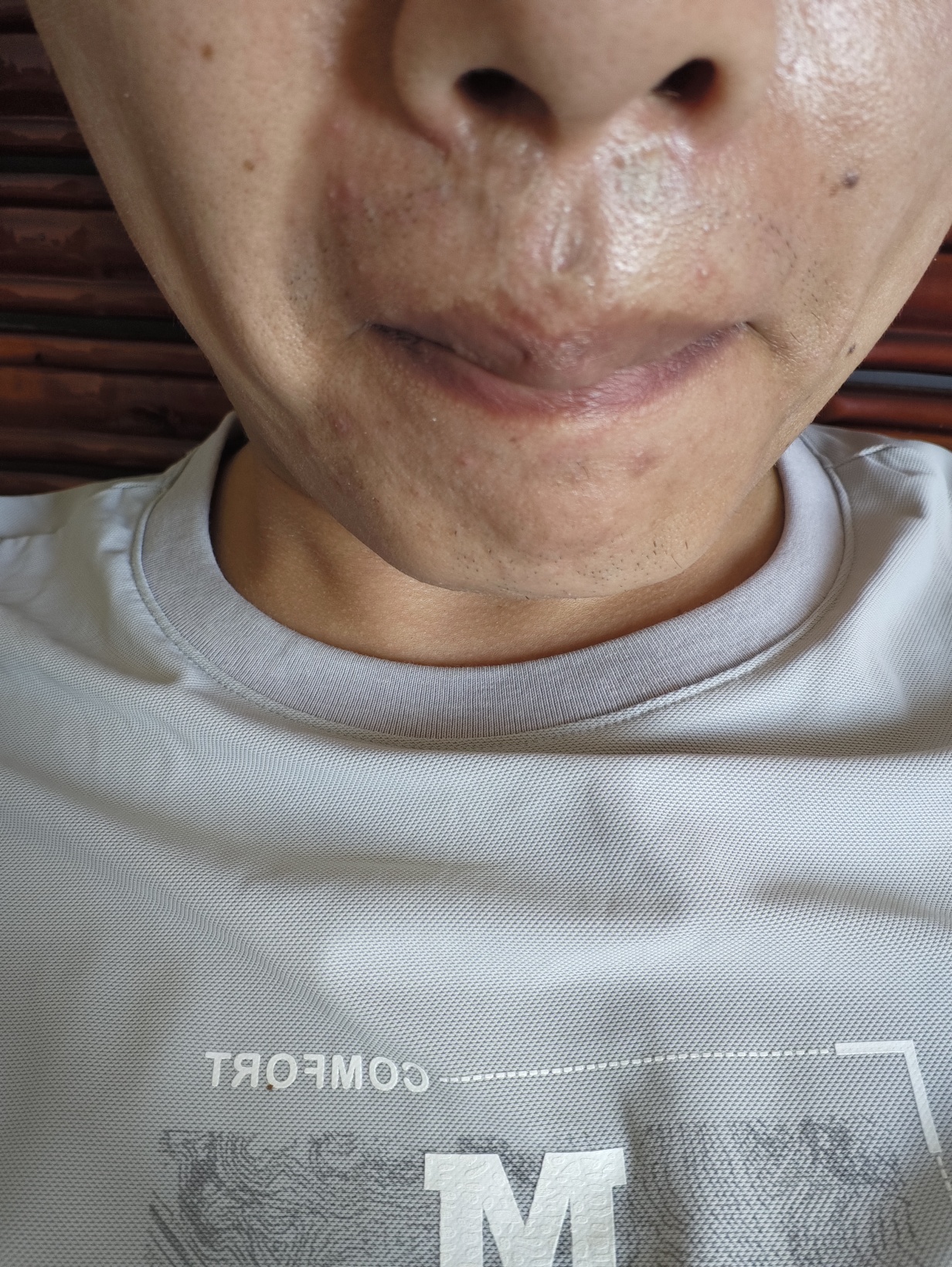 第一次点陈激光，感觉没啥用 
