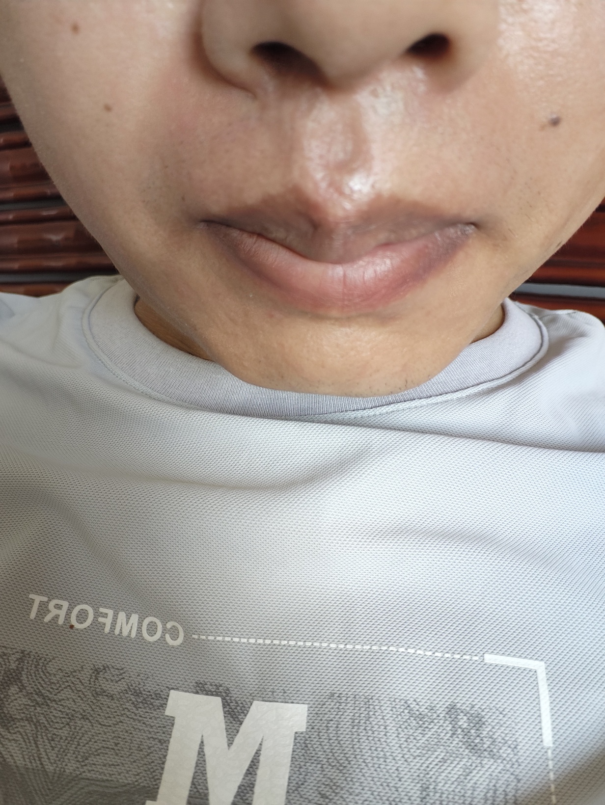 第一次点陈激光，感觉没啥用 