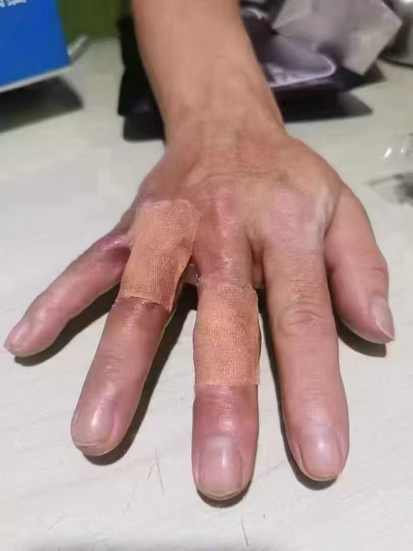 一个多月了一直不愈合，朋友推荐了 