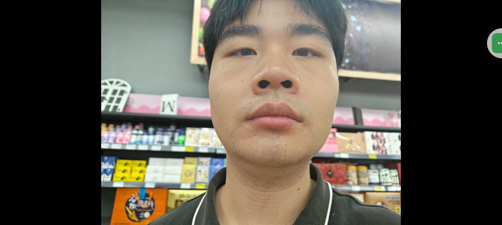 这个疤痕一年还有改善空间吗 