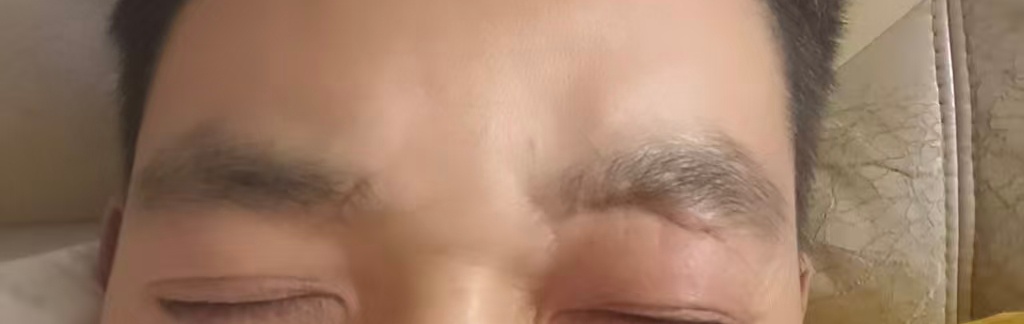 疤友们，这种摔伤后的疤痕怎么破， 