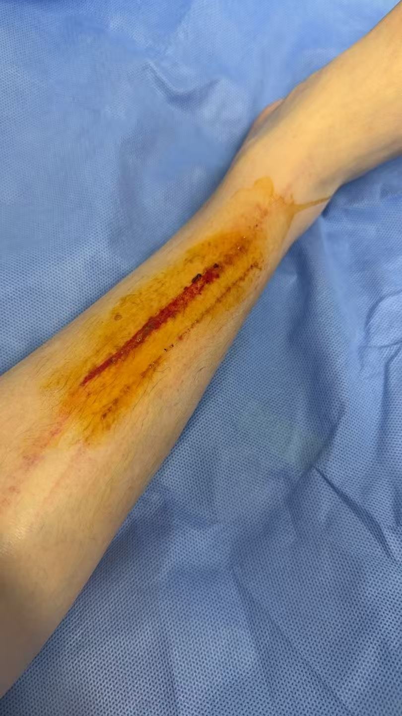 怎么护理不留那么明显的疤呀？ 