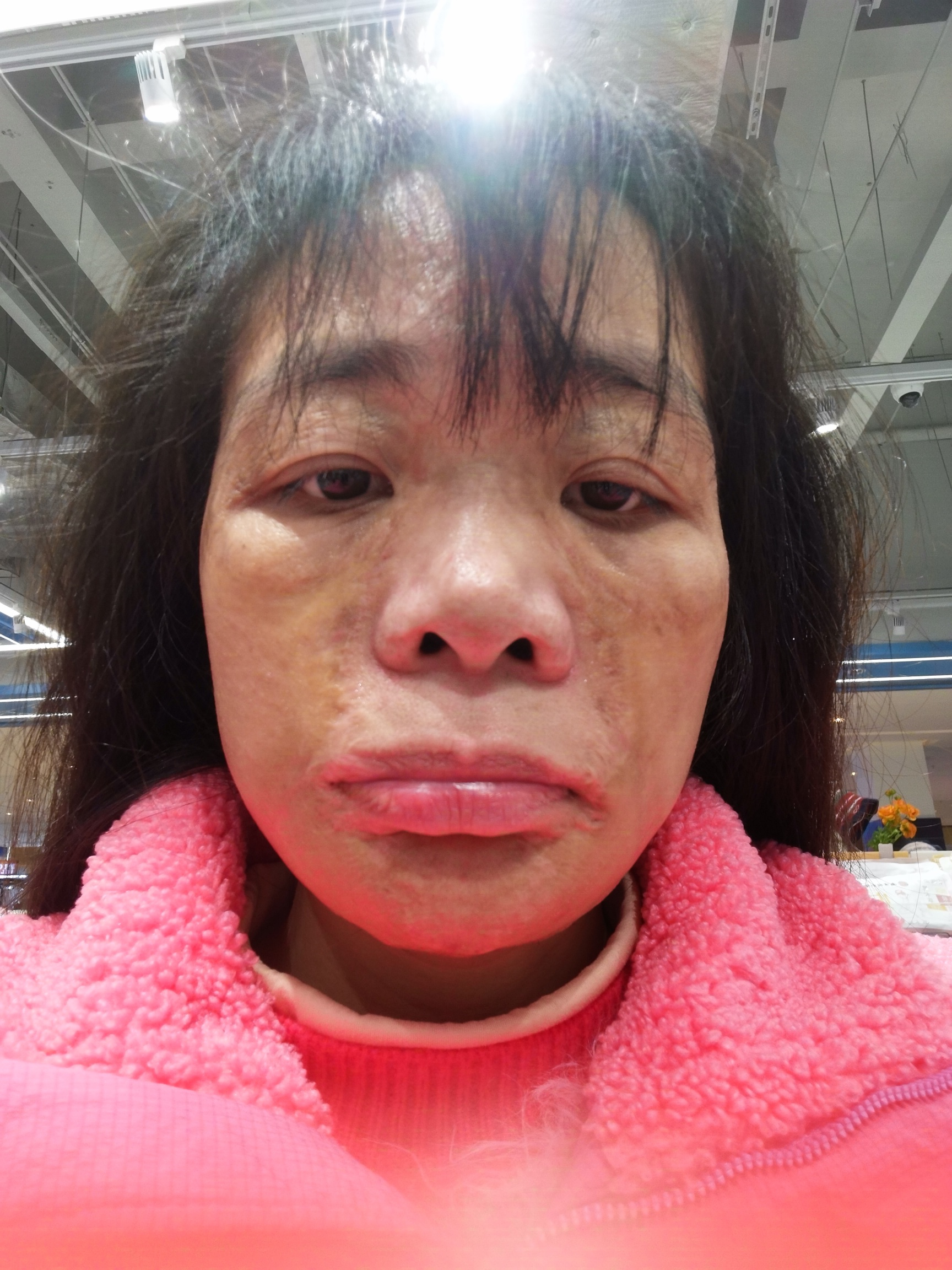 这个面部烫伤疤痕怎么治疗好？ 