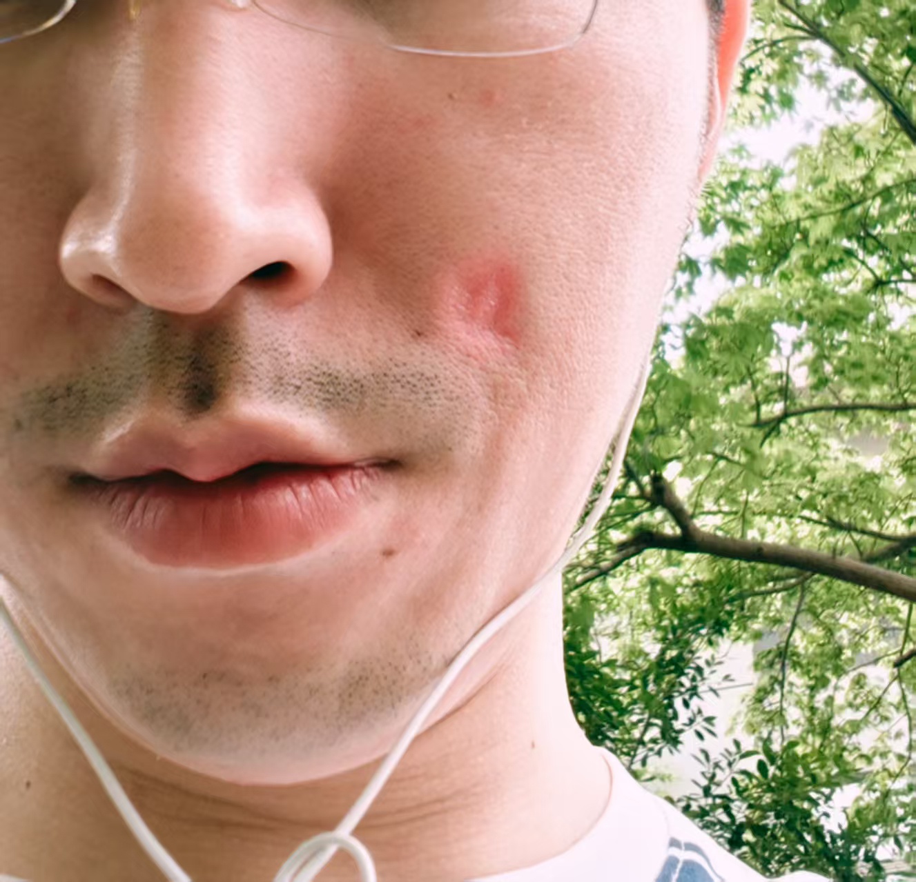 脸上深的凹陷疤痕，可以扩张器治疗吗？ 