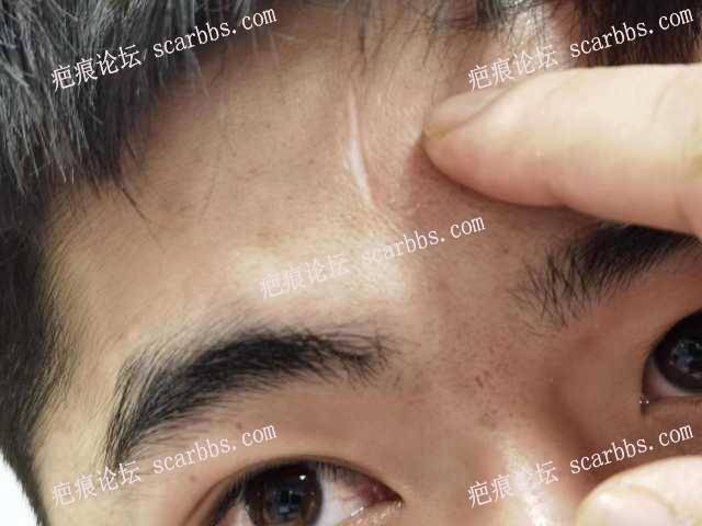 额头凹陷疤痕术后五年恢复情况 
