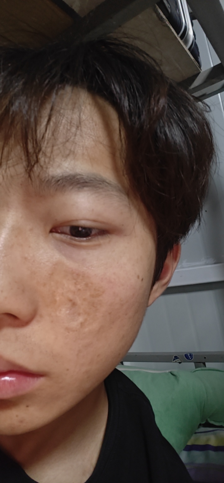 这种烫伤疤痕应该怎么治疗呢 
