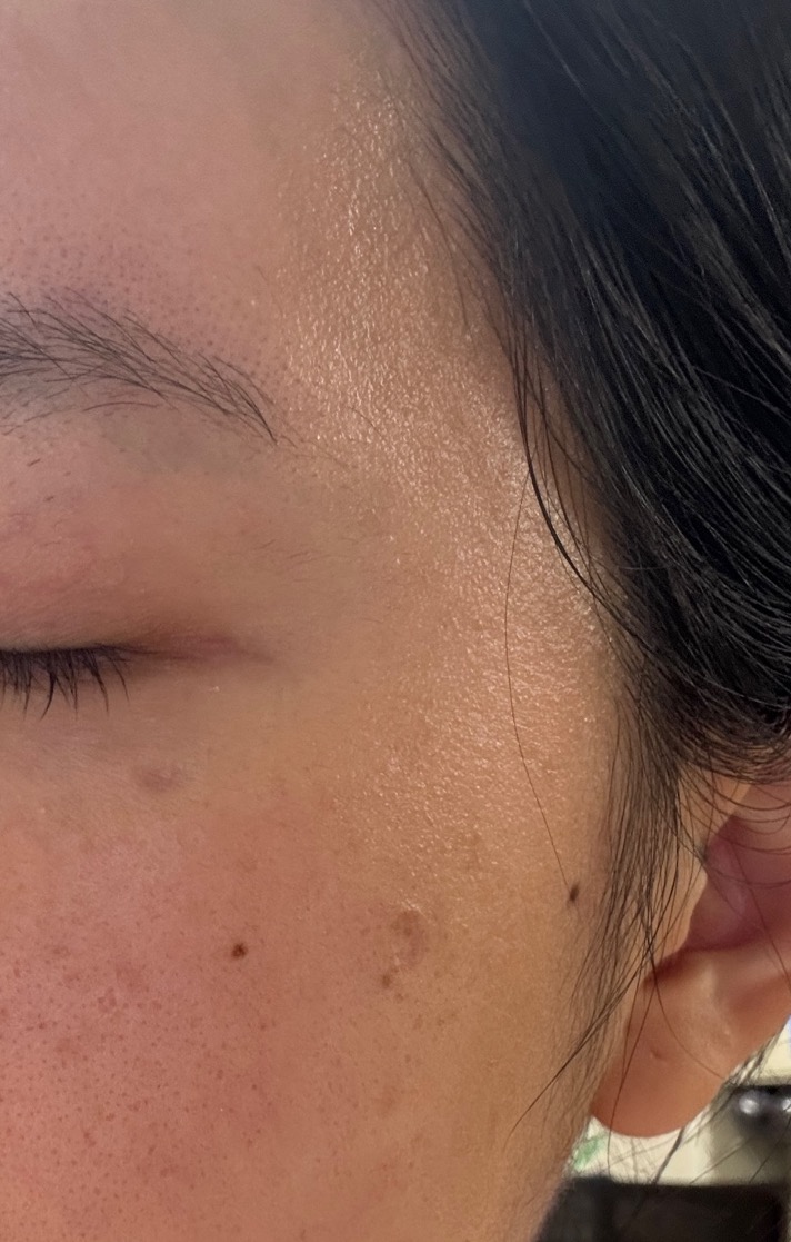 两处激光点痣留下的凹陷性疤痕十余 