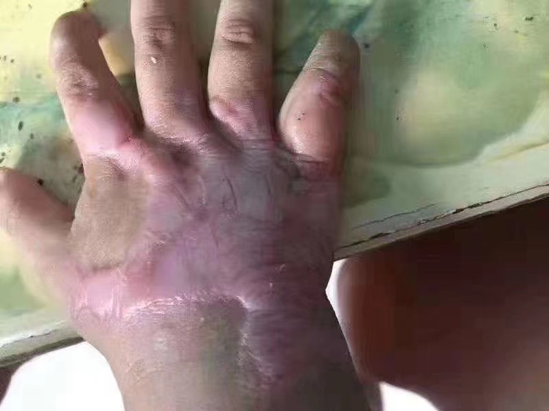 孩子手上烫伤增生的那段日子，大概 