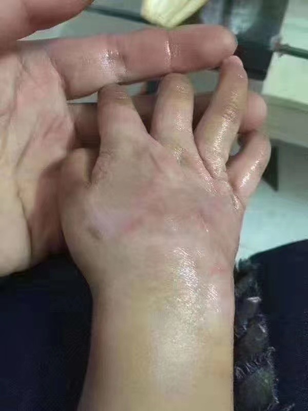 孩子手上烫伤增生的那段日子，大概 